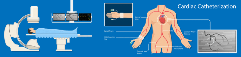 Illustration depicting cardiac catheterization