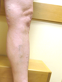 Patient's leg after an ablation procedure