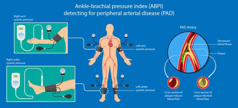 Illustration depicting ankle-brachial pressure index used for detecting peripheral arterial disease