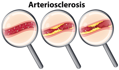 Three magnifying glasses illustrating arteriosclerosis