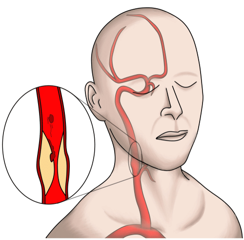 Illustration of carotid artery stenosis