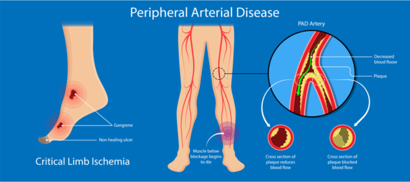 Illustration depicting peripheral arterial disease