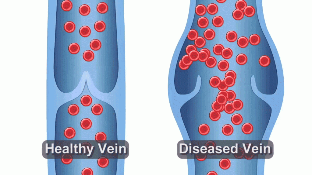 Illustration of a healthy vein versus a diseased vein
